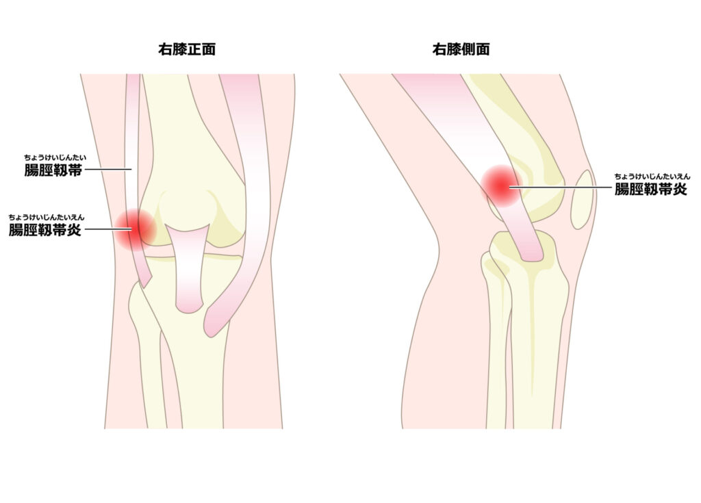 腸脛靭帯炎：膝が痛い人が腸脛靭帯炎になって八広駅前整骨院でマッサージ治療を受けるイラスト