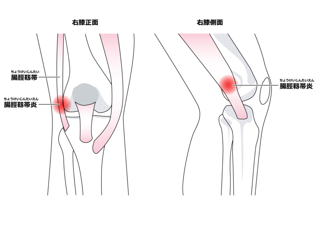 ランナー膝：膝が痛い人がランナー膝になって八広駅前整骨院で整体・マッサージ治療を受けるイラスト