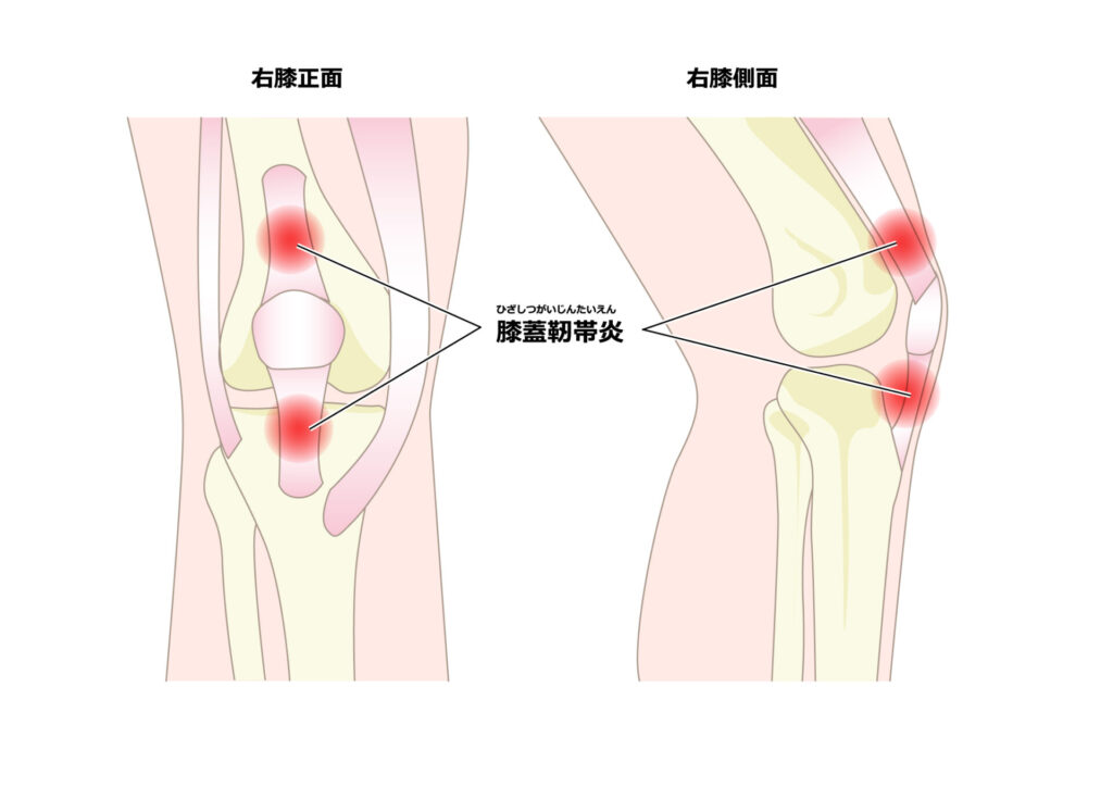 膝蓋靭帯炎：膝が痛い人が膝蓋靭帯炎になって八広駅前整骨院で整体・マッサージ治療を受けるイラスト