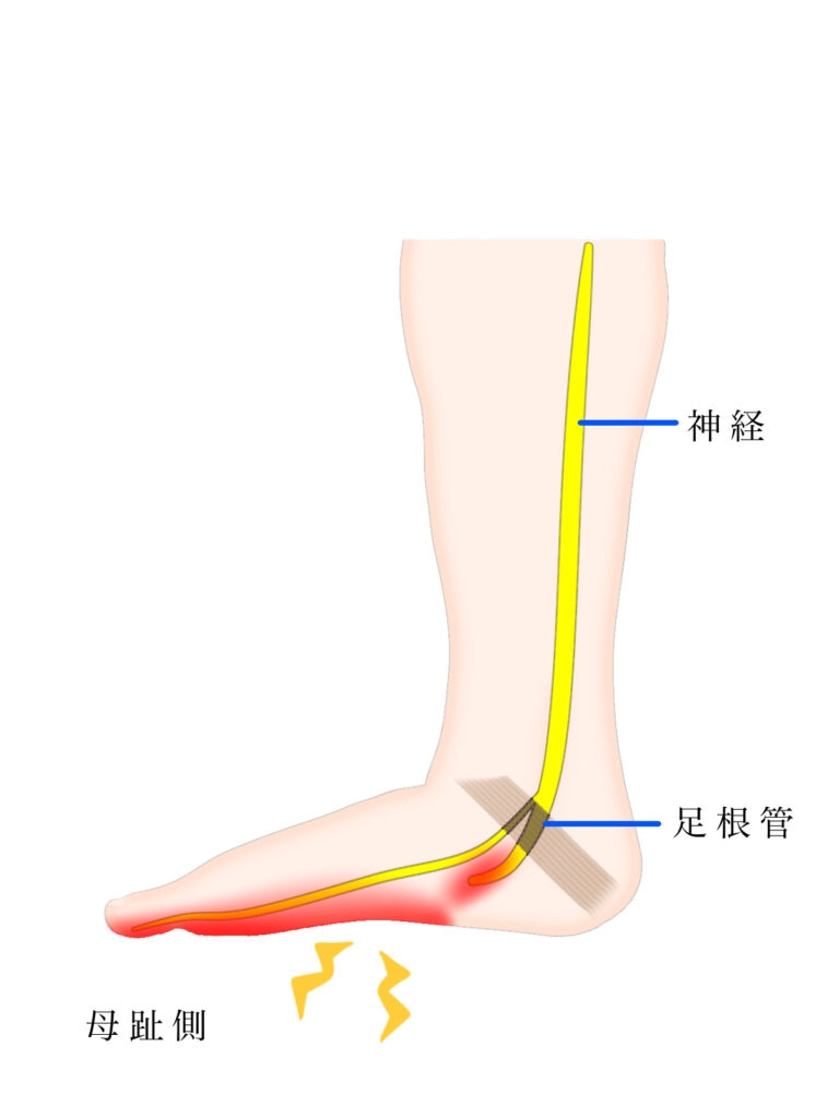 足の足根管症候群のイラスト：八広駅前整骨院