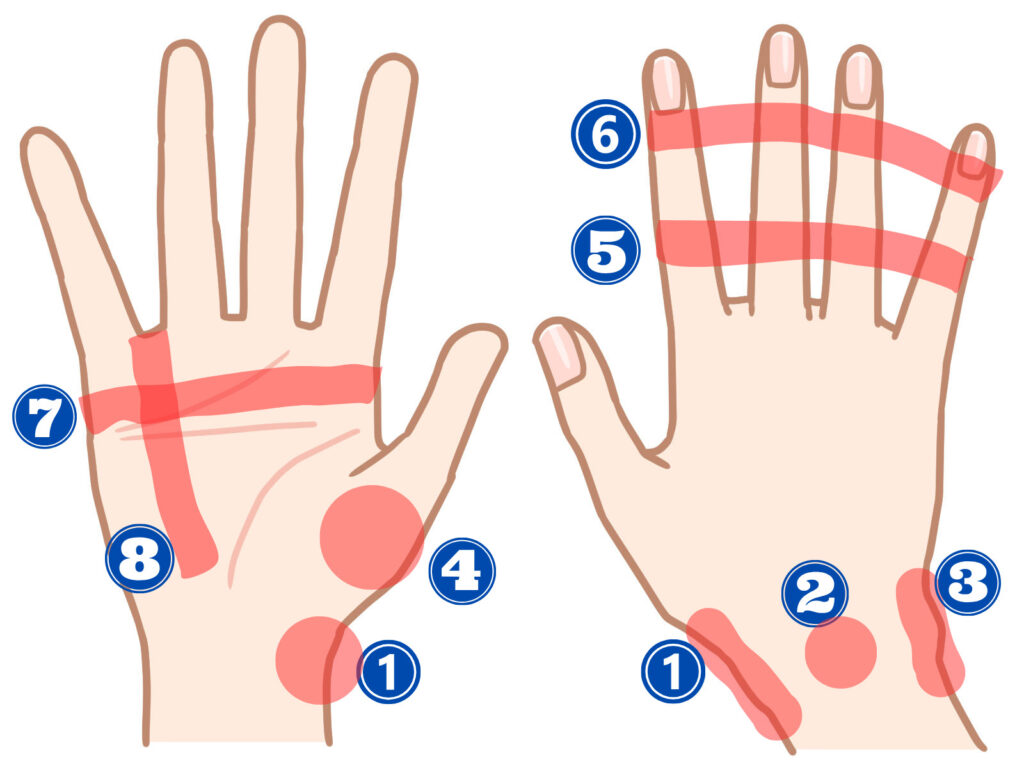 手～指にかけての痛みのポイントと疾患名を明記したイラスト画像